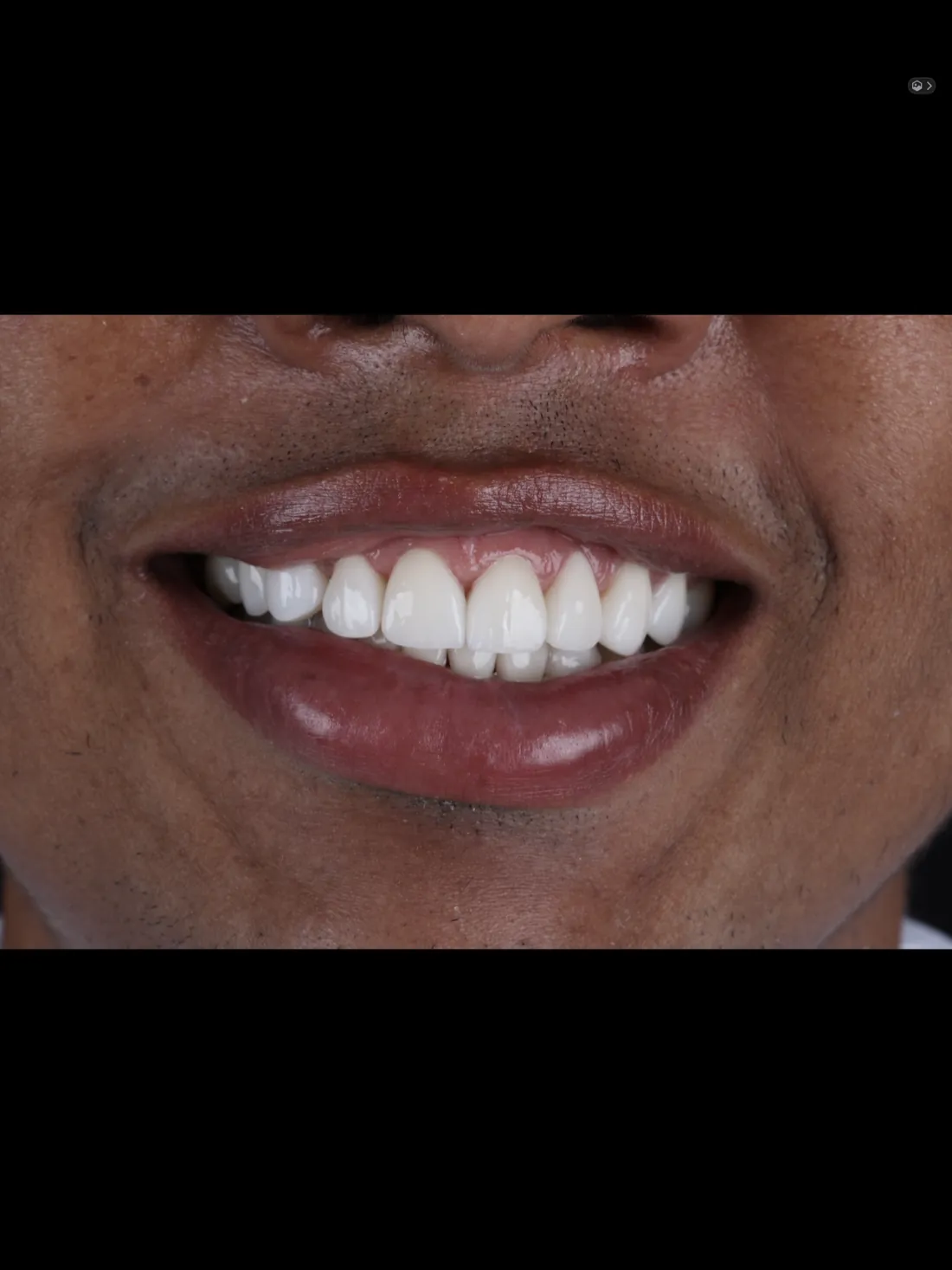 Sonrisa después del tratamiento