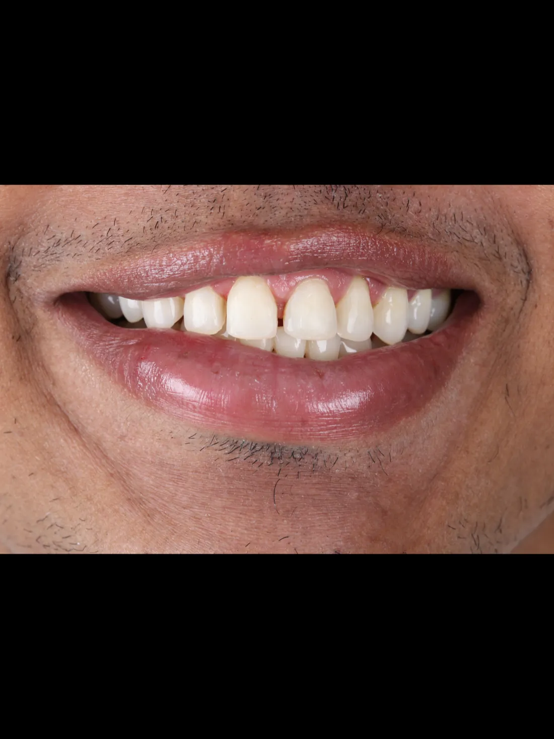 Sonrisa antes del tratamiento